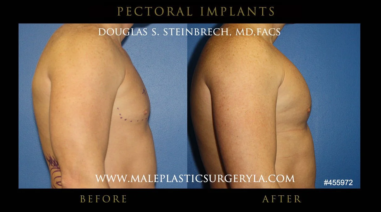 Pectoral Chest Implant - Before & After Photos