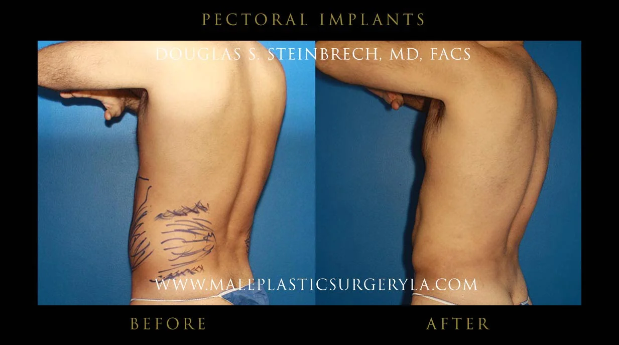 Pectoral Chest Implant - Before & After Photos