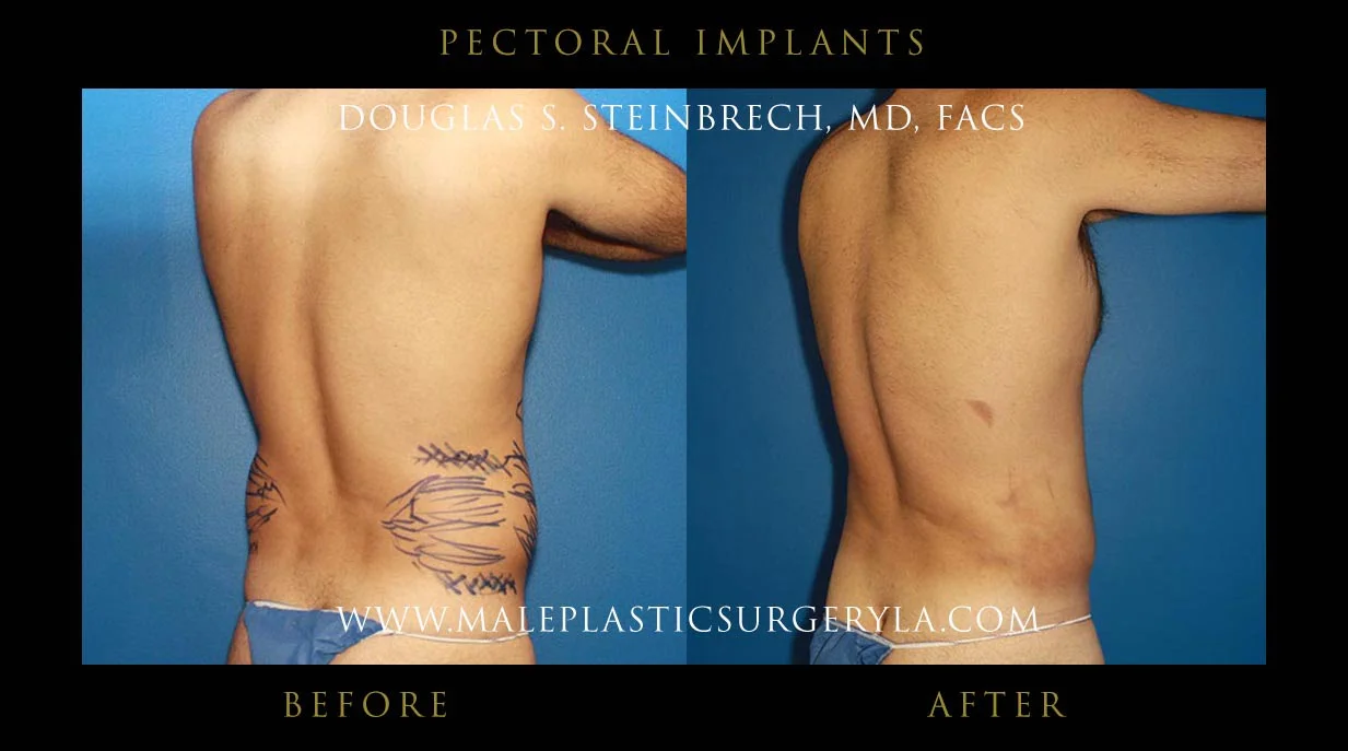 Pectoral Chest Implant - Before & After Photos