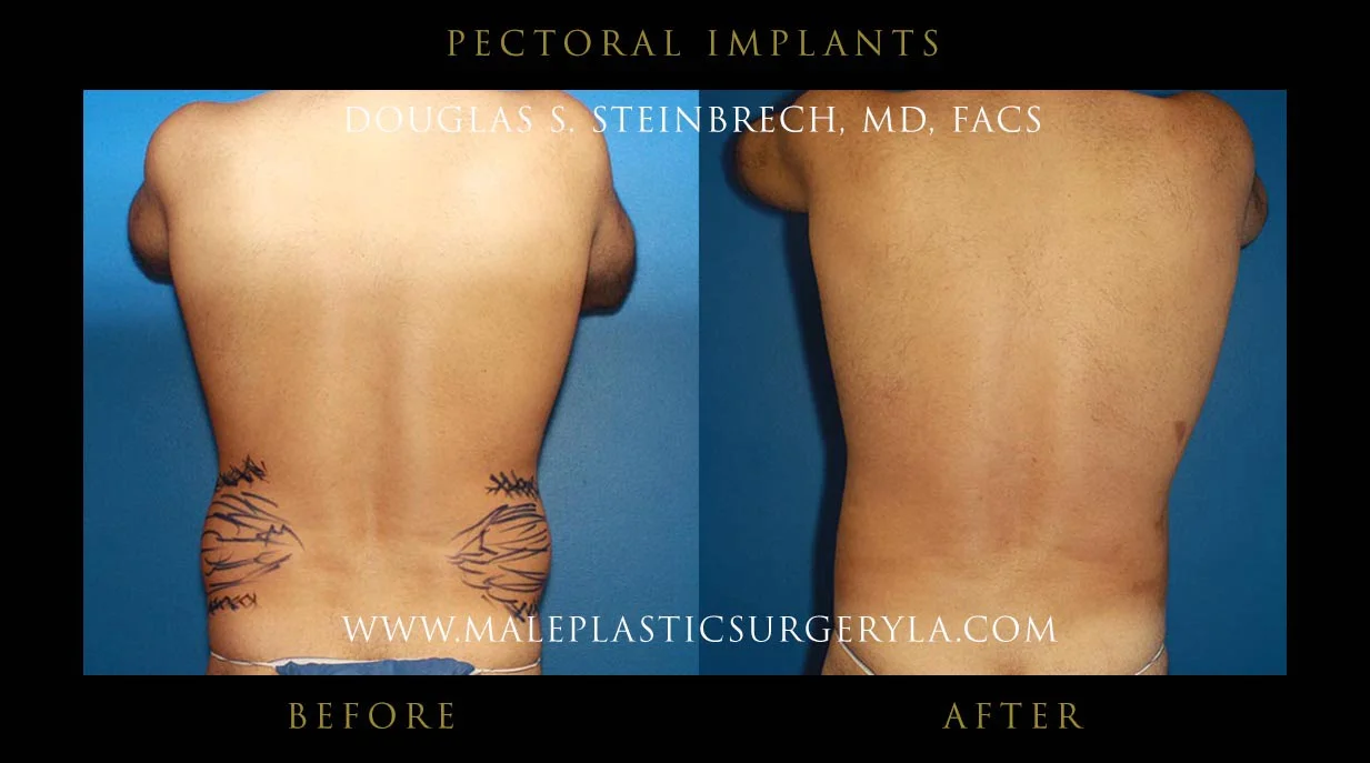 Pectoral Chest Implant - Before & After Photos