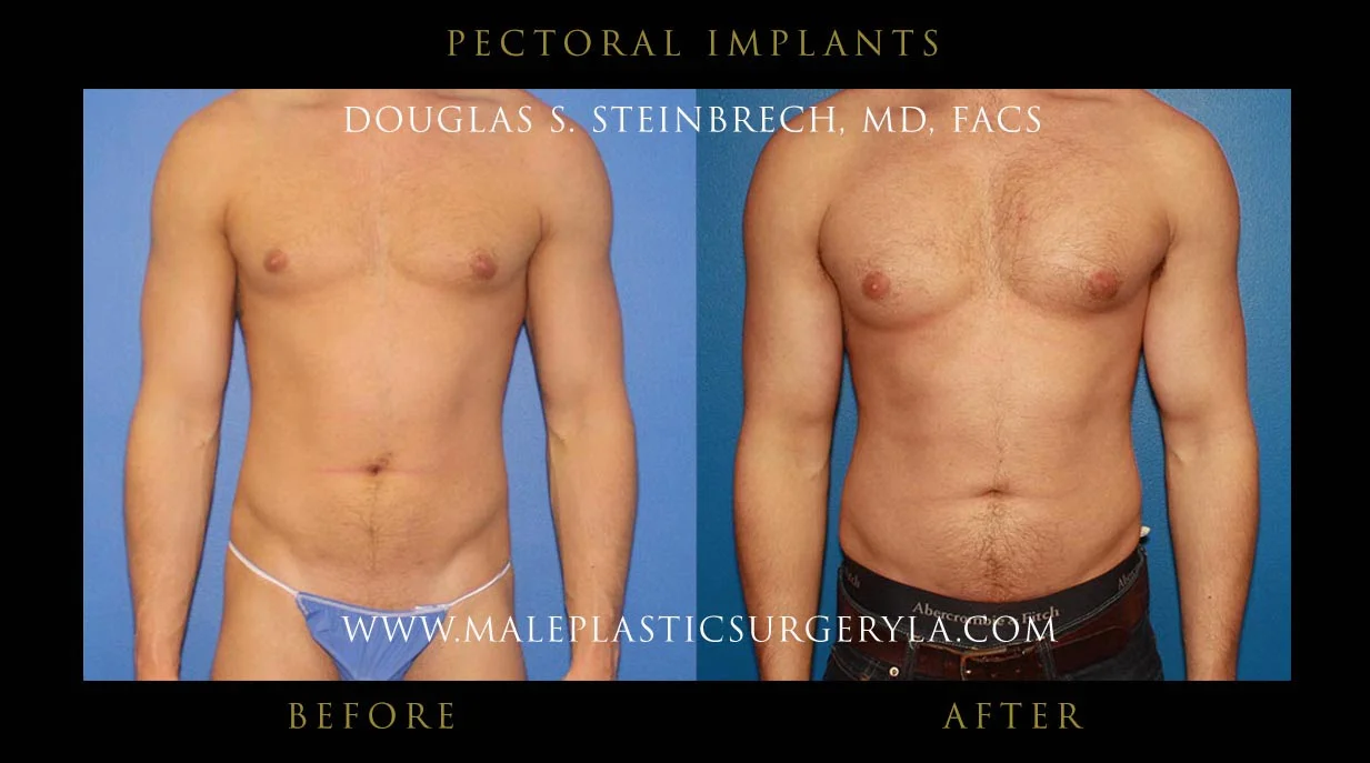 Pectoral Chest Implant - Before & After Photos