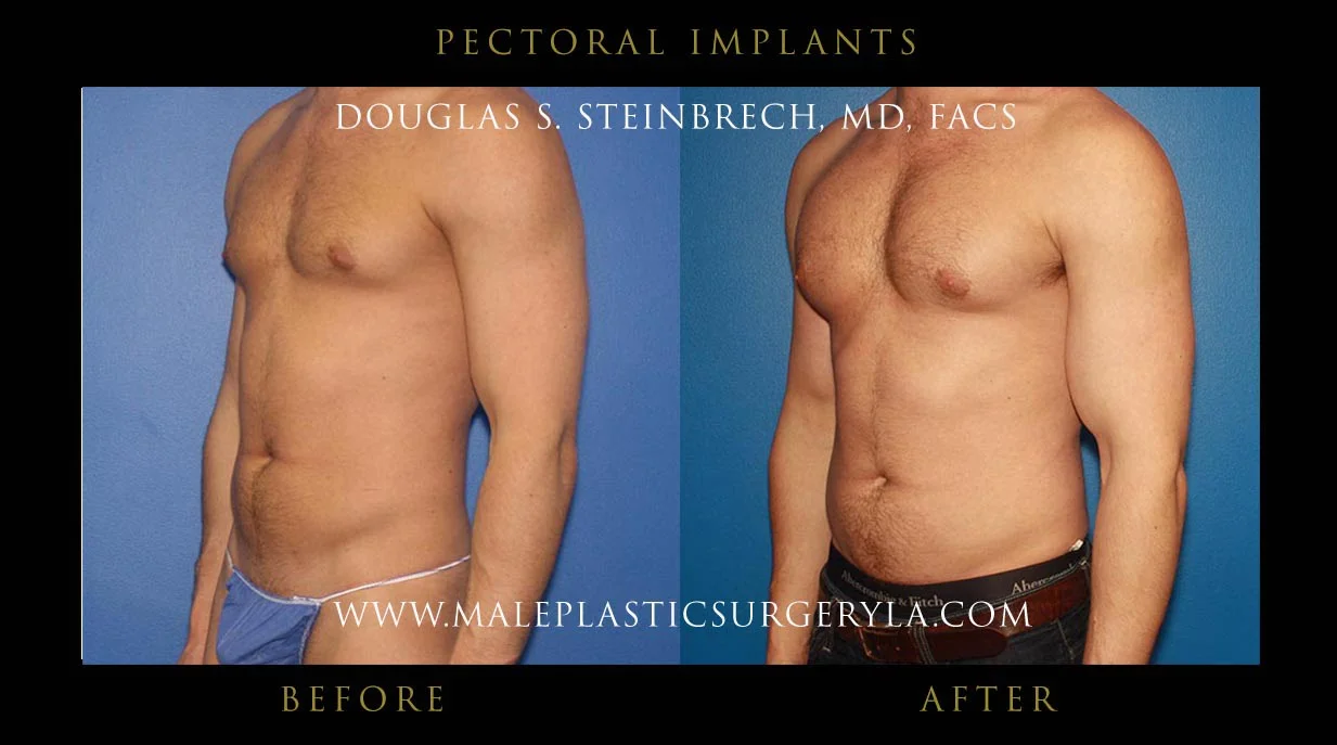 Pectoral Chest Implant - Before & After Photos