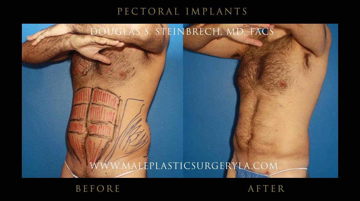 Pectoral Chest Implant - Before & After Photos