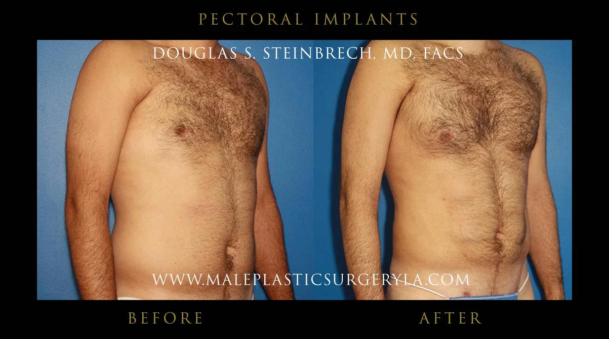 Pectoral Chest Implant - Before & After Photos