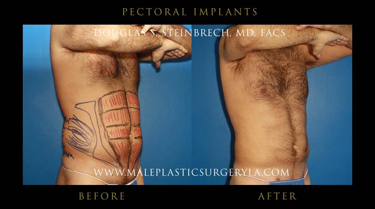 Pectoral Chest Implant - Before & After Photos