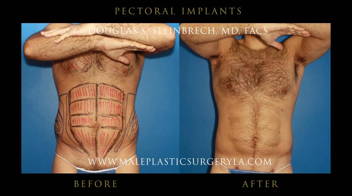 Pectoral Chest Implant - Before & After Photos