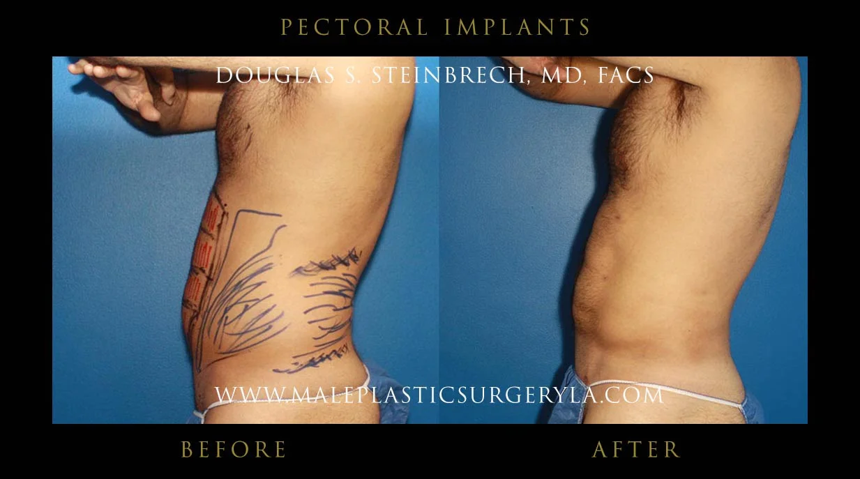 Pectoral Chest Implant - Before & After Photos