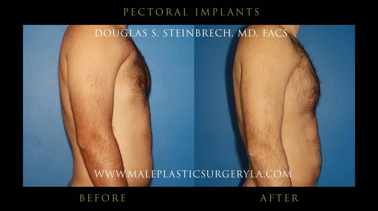 Pectoral Chest Implant - Before & After Photos