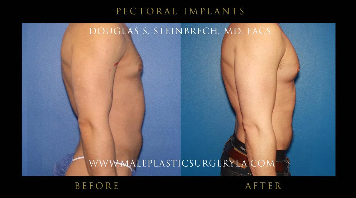 Pectoral Chest Implant - Before & After Photos