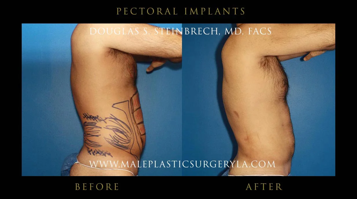 Pectoral Chest Implant - Before & After Photos