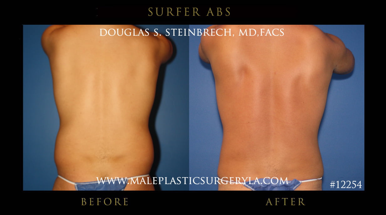 Surfer Abs - Before & After Photos