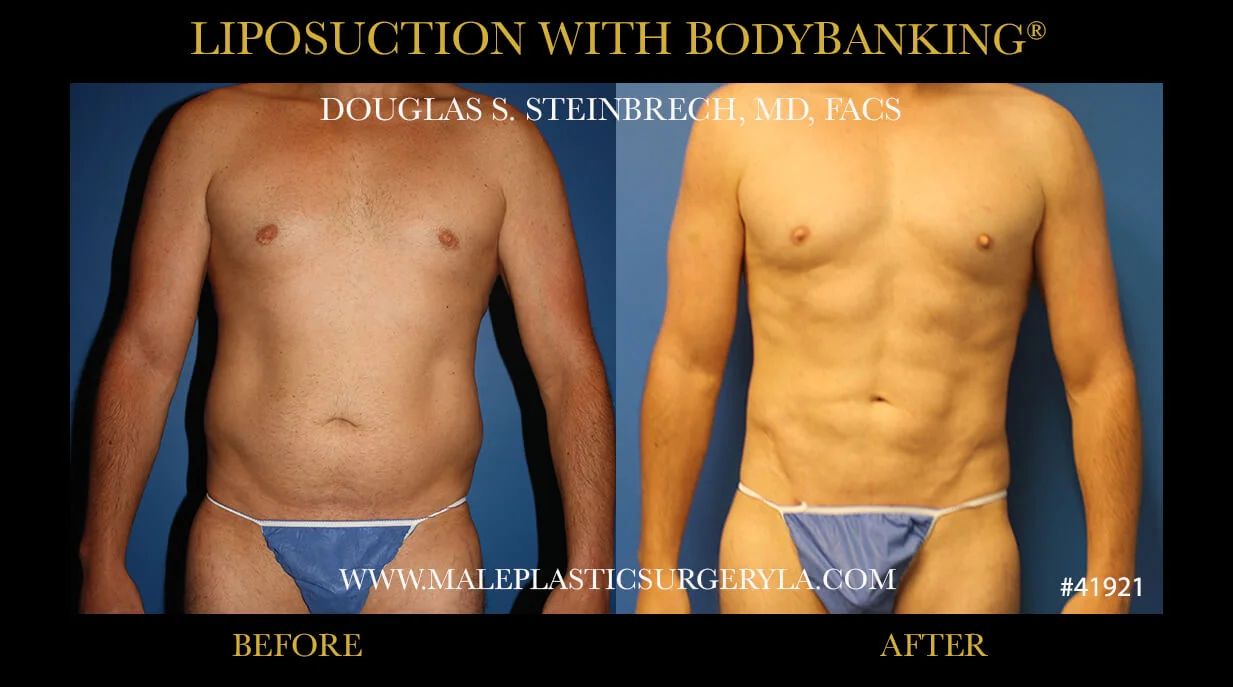 Liposuction - Before & After Photos