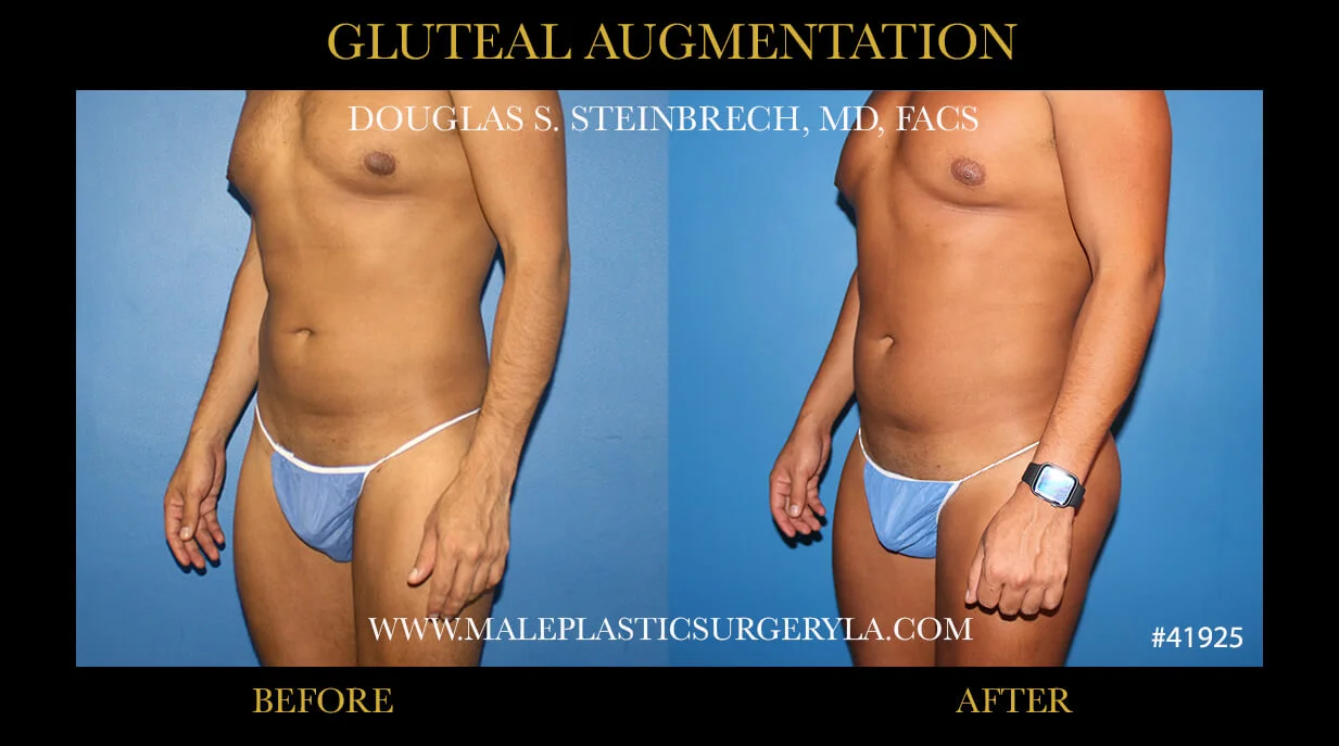 Gluteal Buttock Implants - Before & After Photos