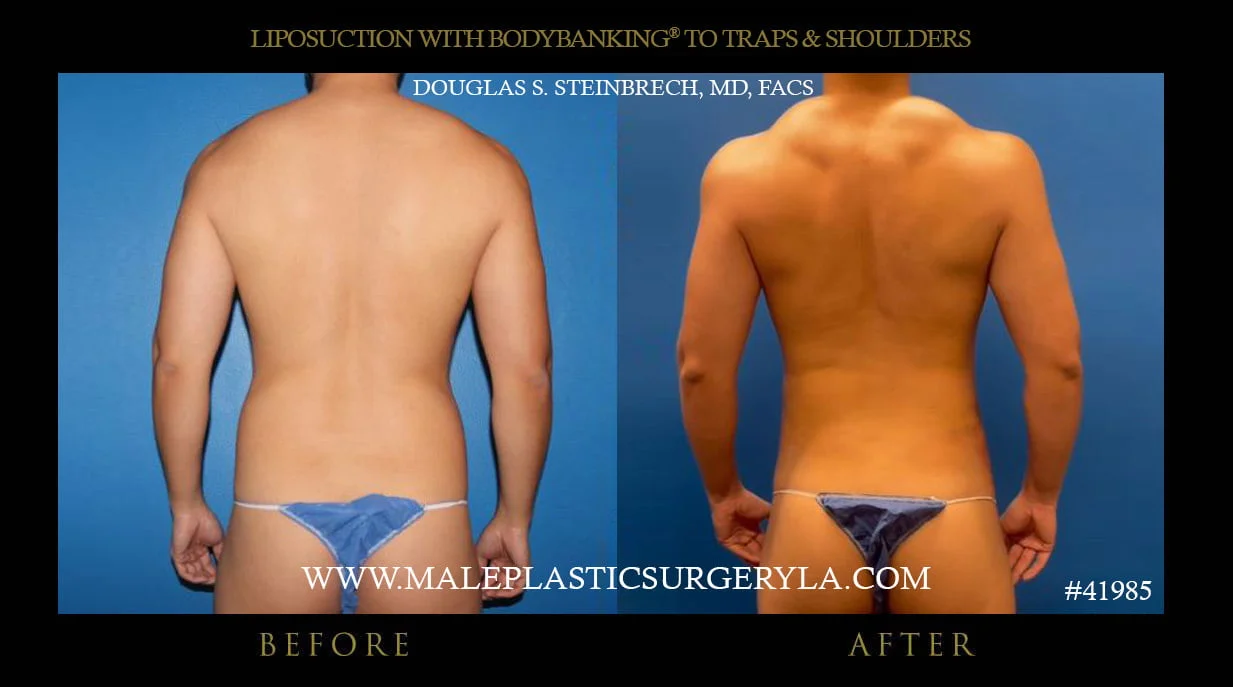 Liposuction - Before & After Photos