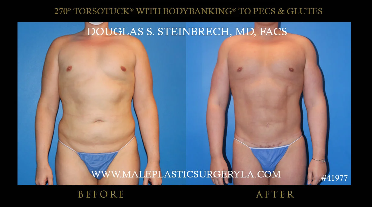 Torsotuck - Before & After Photos