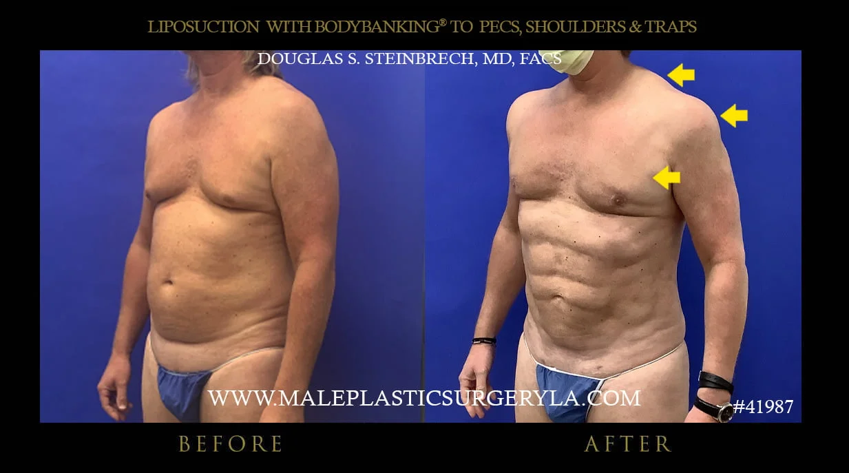 Liposuction - Before & After Photos