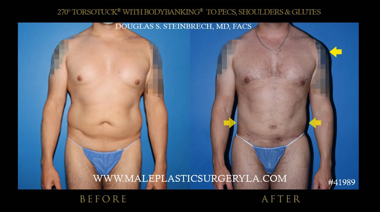 Torsotuck - Before & After Photos