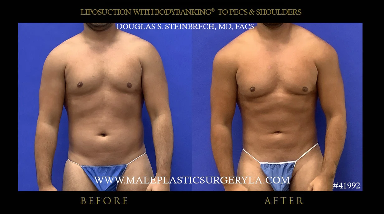 Liposuction - Before & After Photos