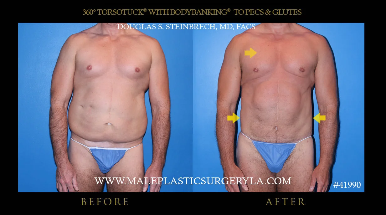 Torsotuck - Before & After Photos