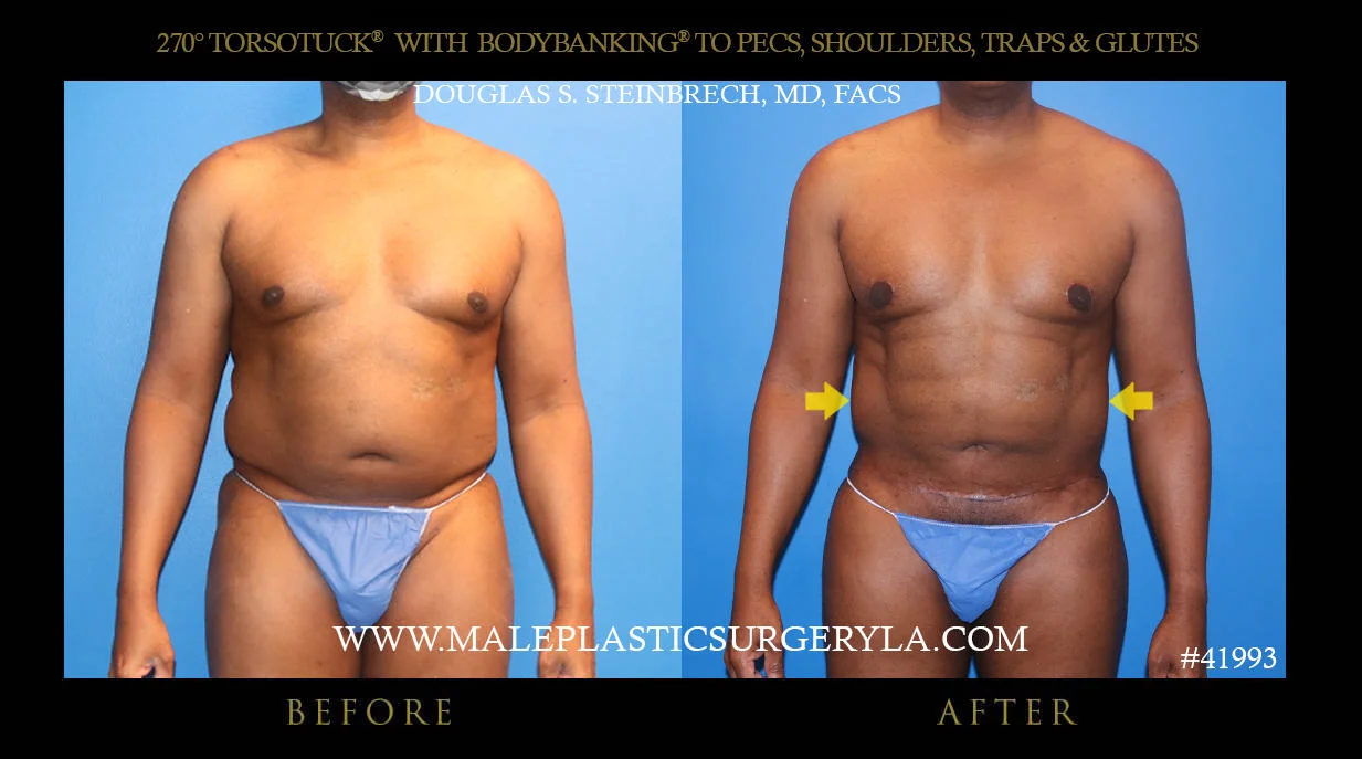 Torsotuck - Before & After Photos