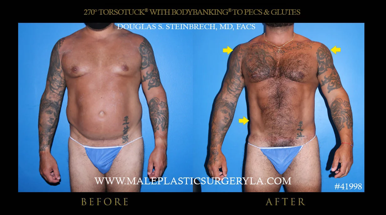 Torsotuck - Before & After Photos