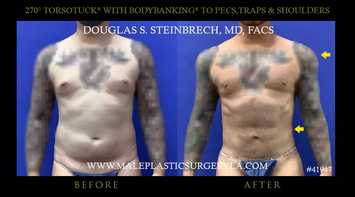 Torsotuck - Before & After Photos