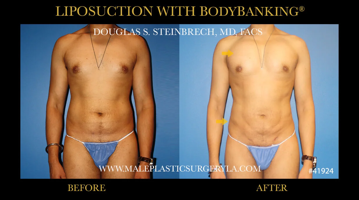 Liposuction - Before & After Photos