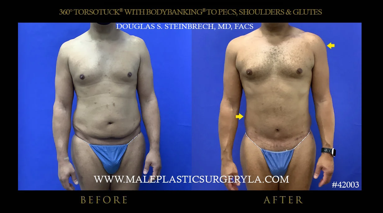 Torsotuck - Before & After Photos