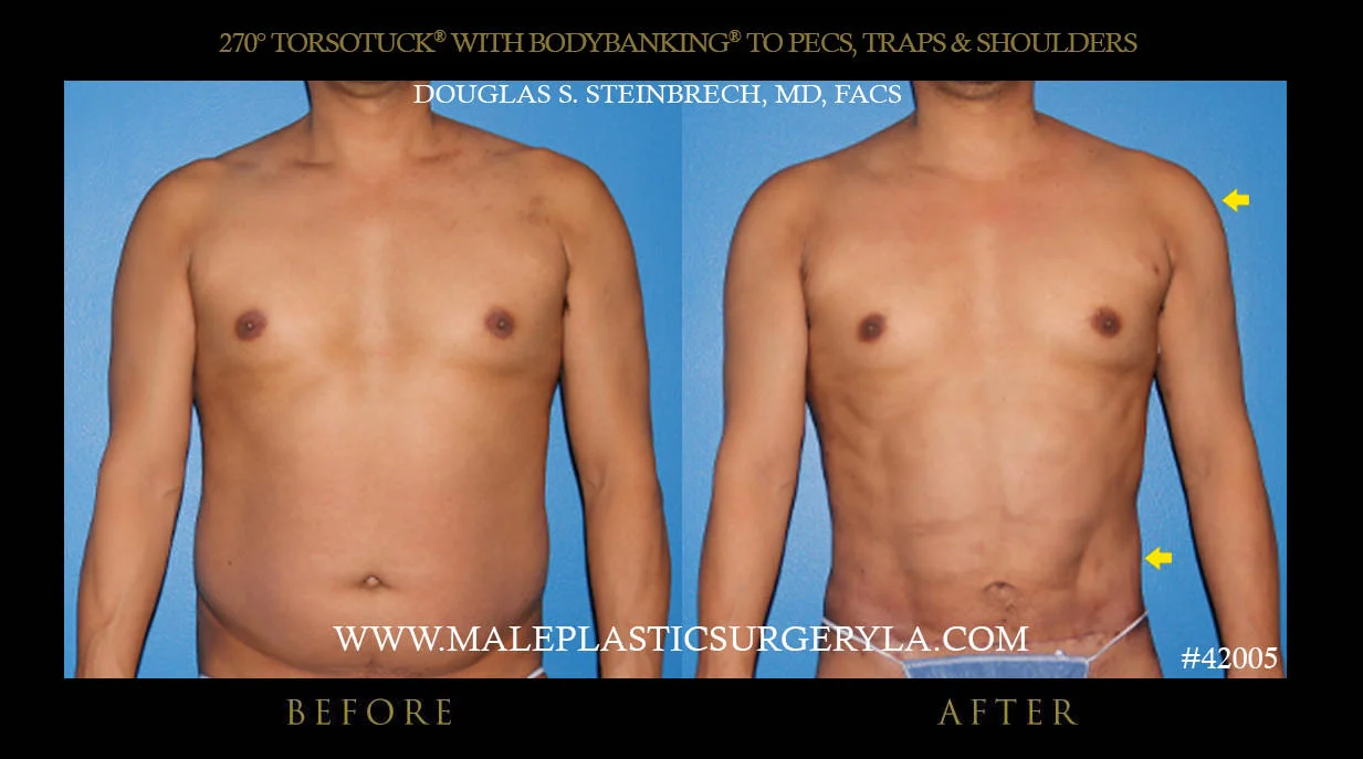 Torsotuck - Before & After Photos