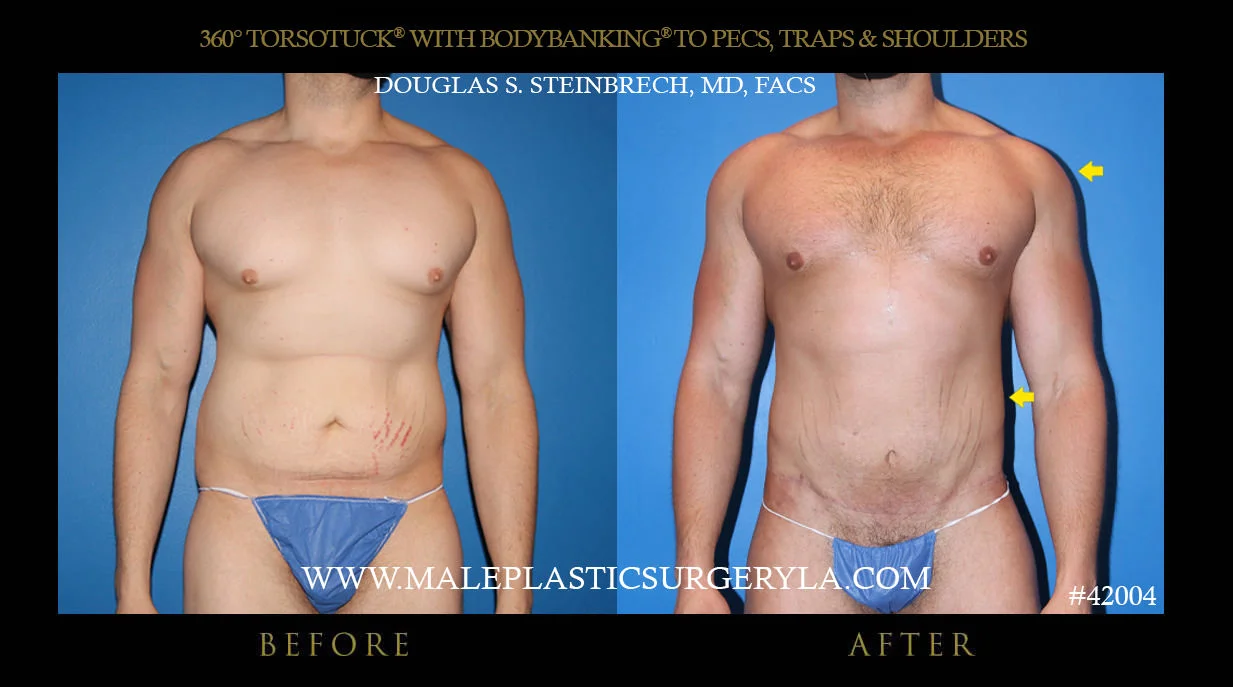 Torsotuck - Before & After Photos