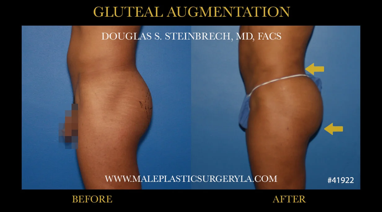 Gluteal Buttock Implants - Before & After Photos