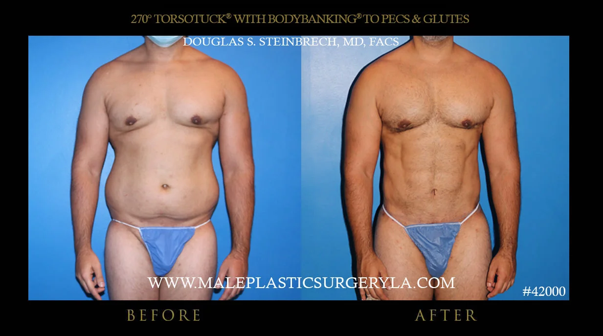 Torsotuck - Before & After Photos