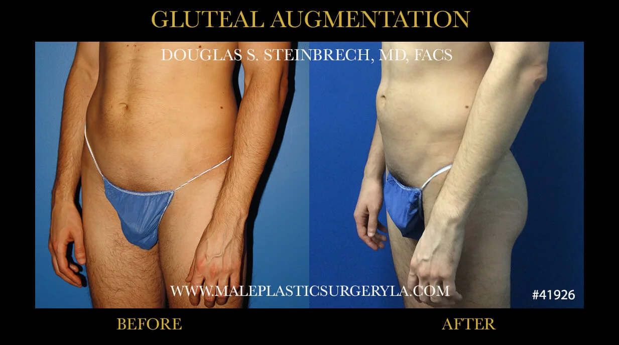 Gluteal Buttock Implants - Before & After Photos