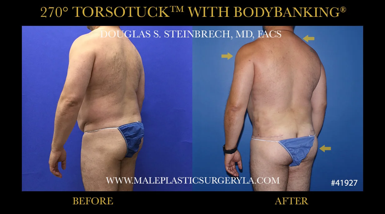 Torsotuck - Before & After Photos