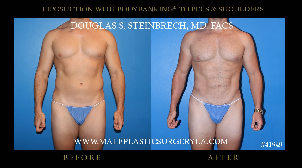 Liposuction - Before & After Photos