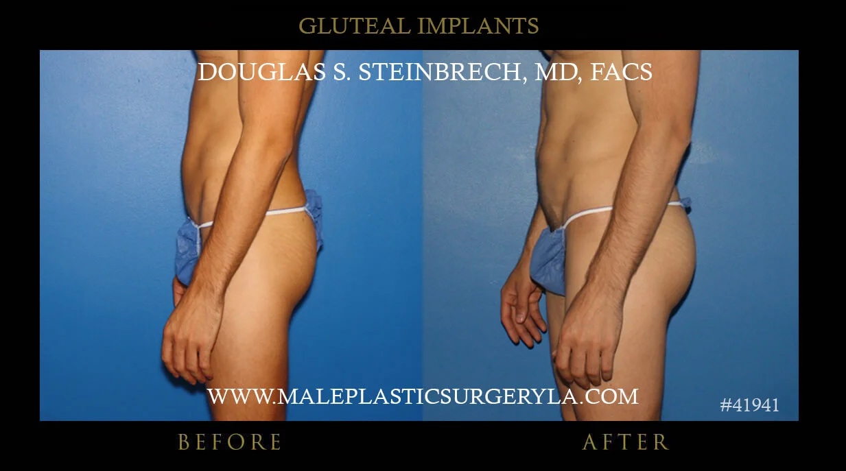 Gluteal Buttock Implants - Before & After Photos