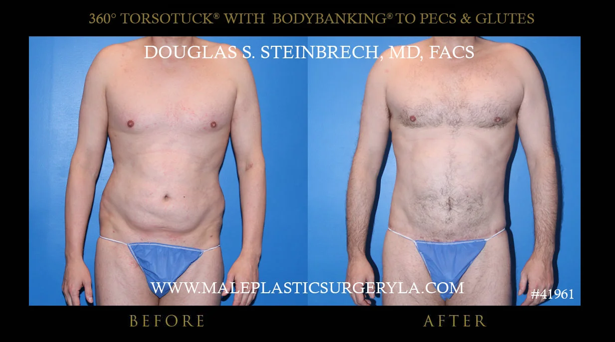 Torsotuck - Before & After Photos