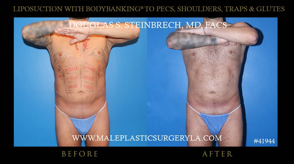 Liposuction - Before & After Photos