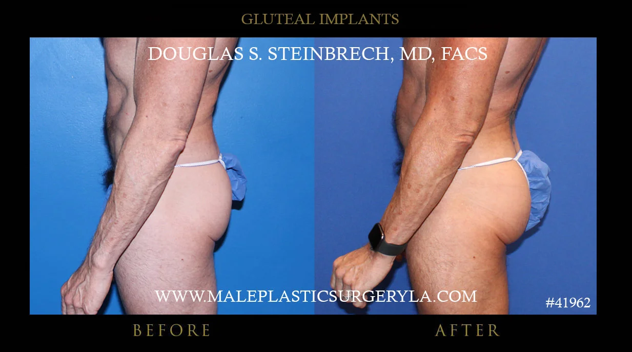 Gluteal Buttock Implants - Before & After Photos