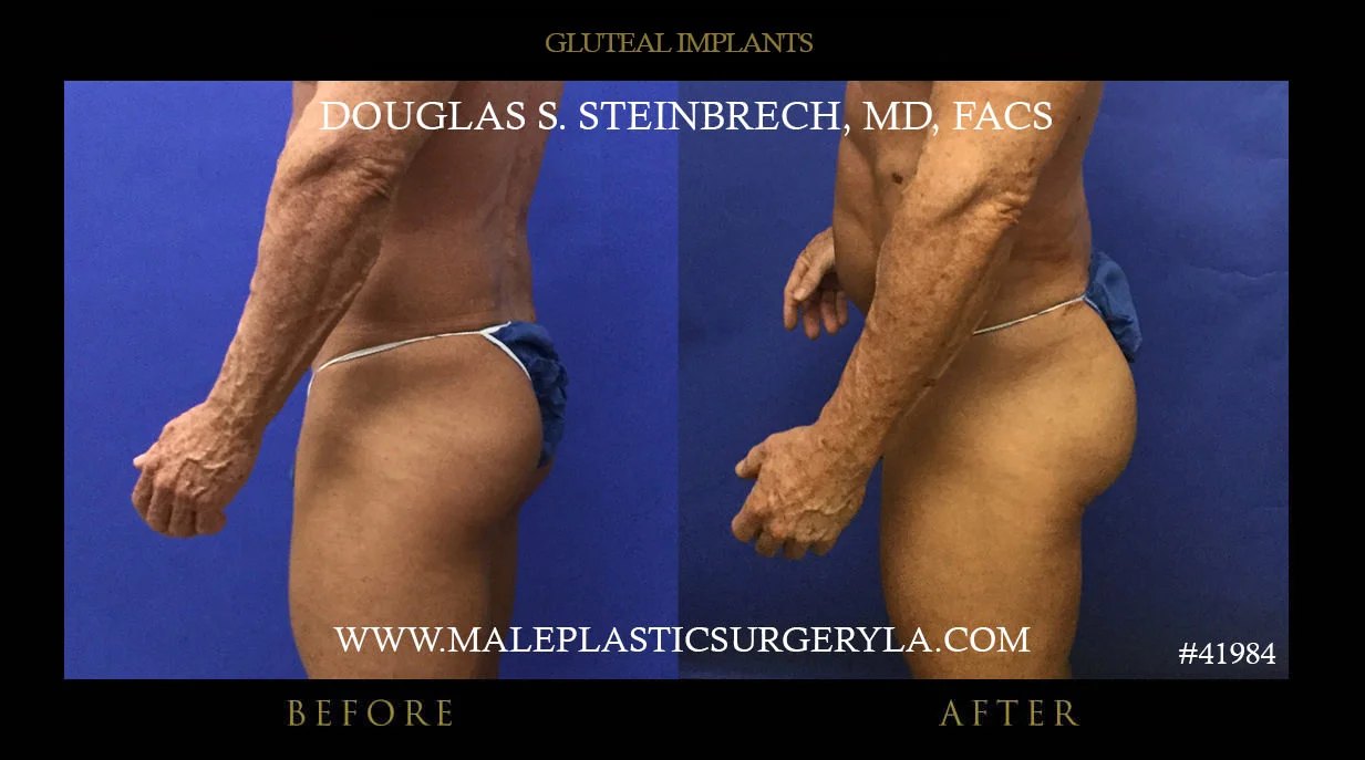 Gluteal Buttock Implants - Before & After Photos