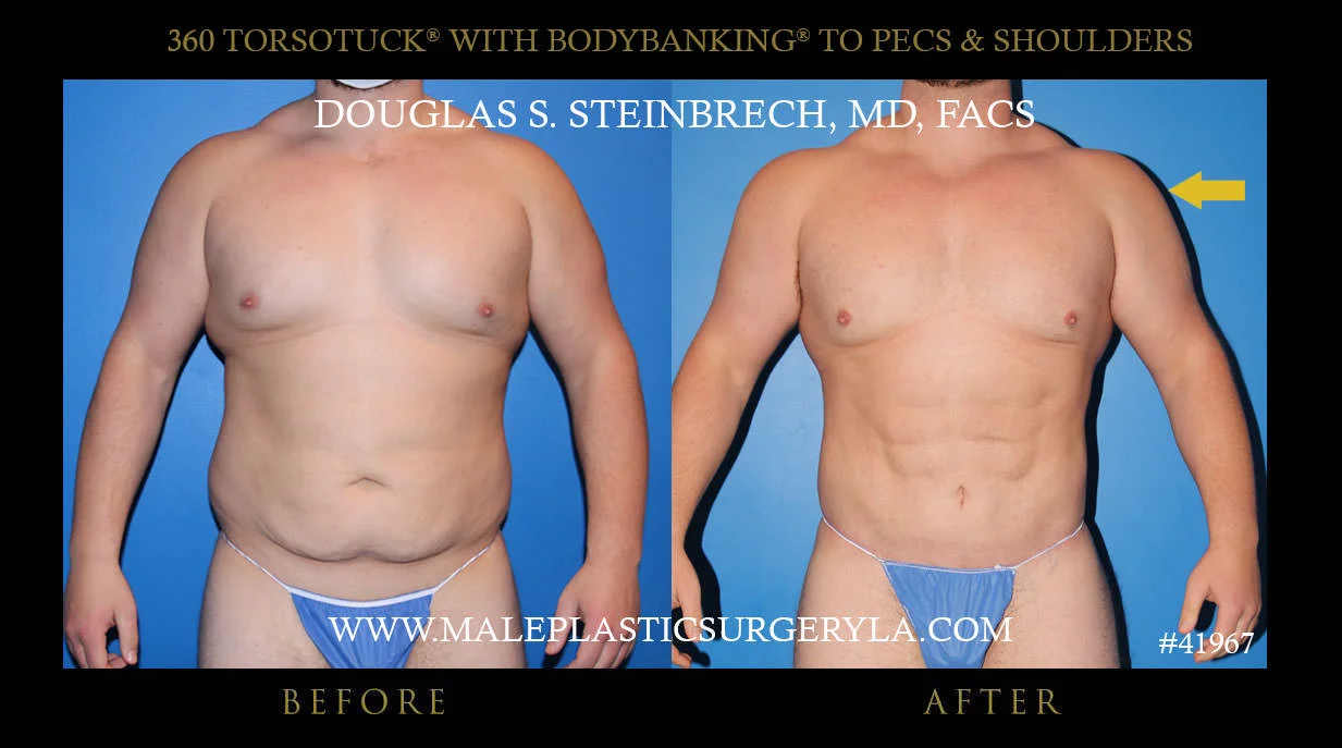 Torsotuck - Before & After Photos