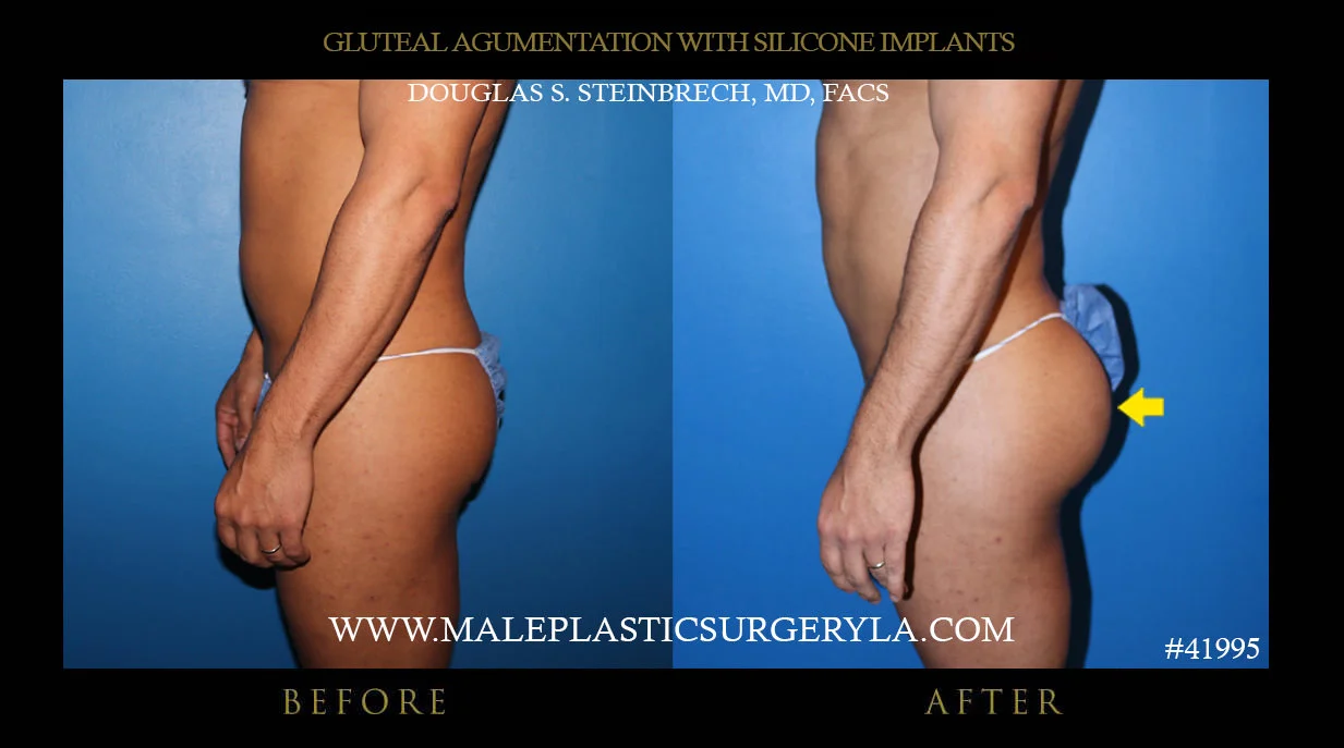 Gluteal Buttock Implants - Before & After Photos