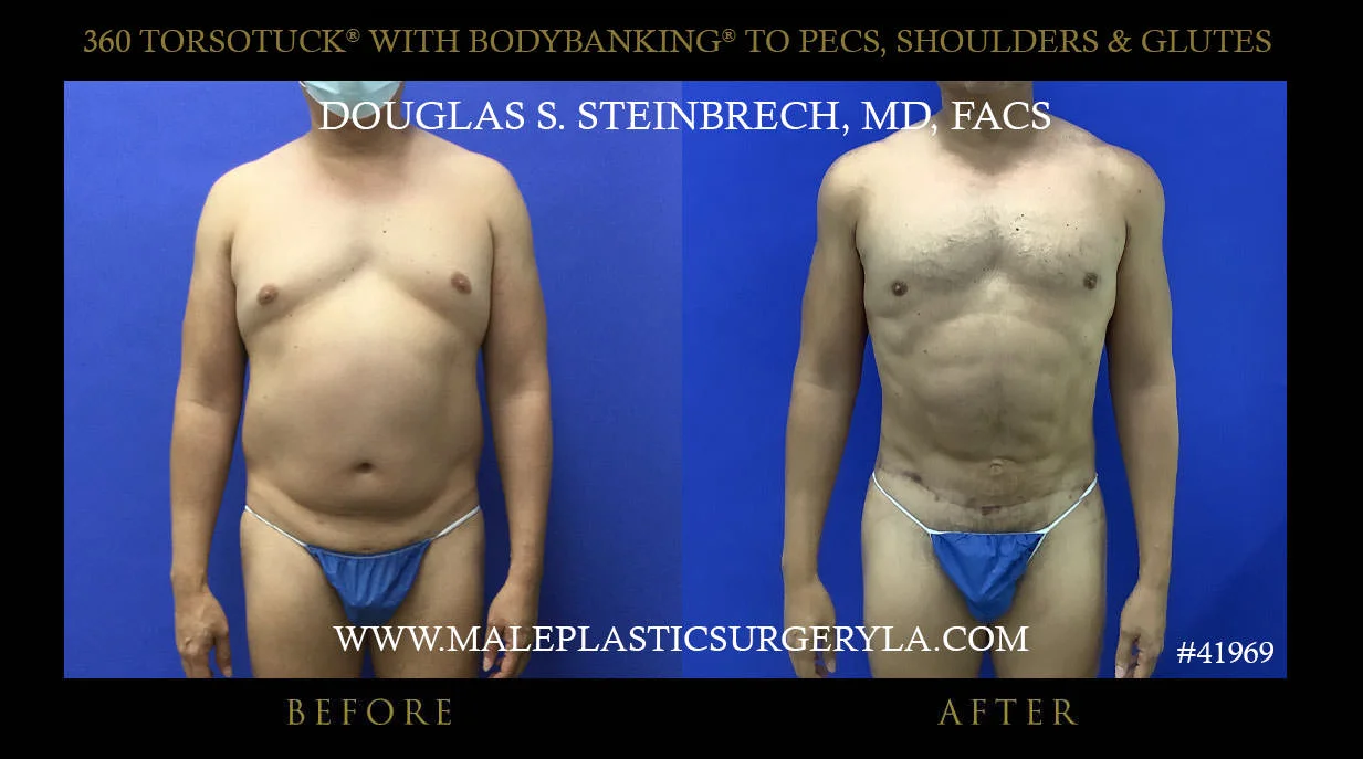 Torsotuck - Before & After Photos