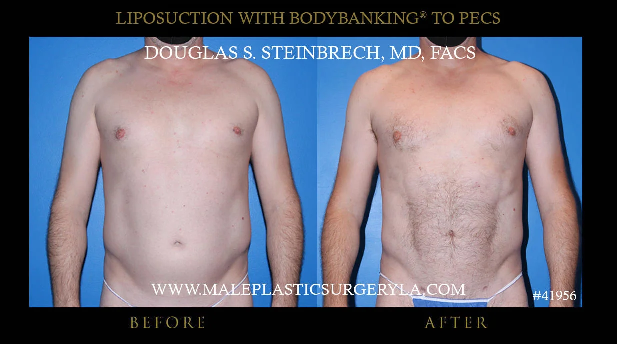 Liposuction - Before & After Photos