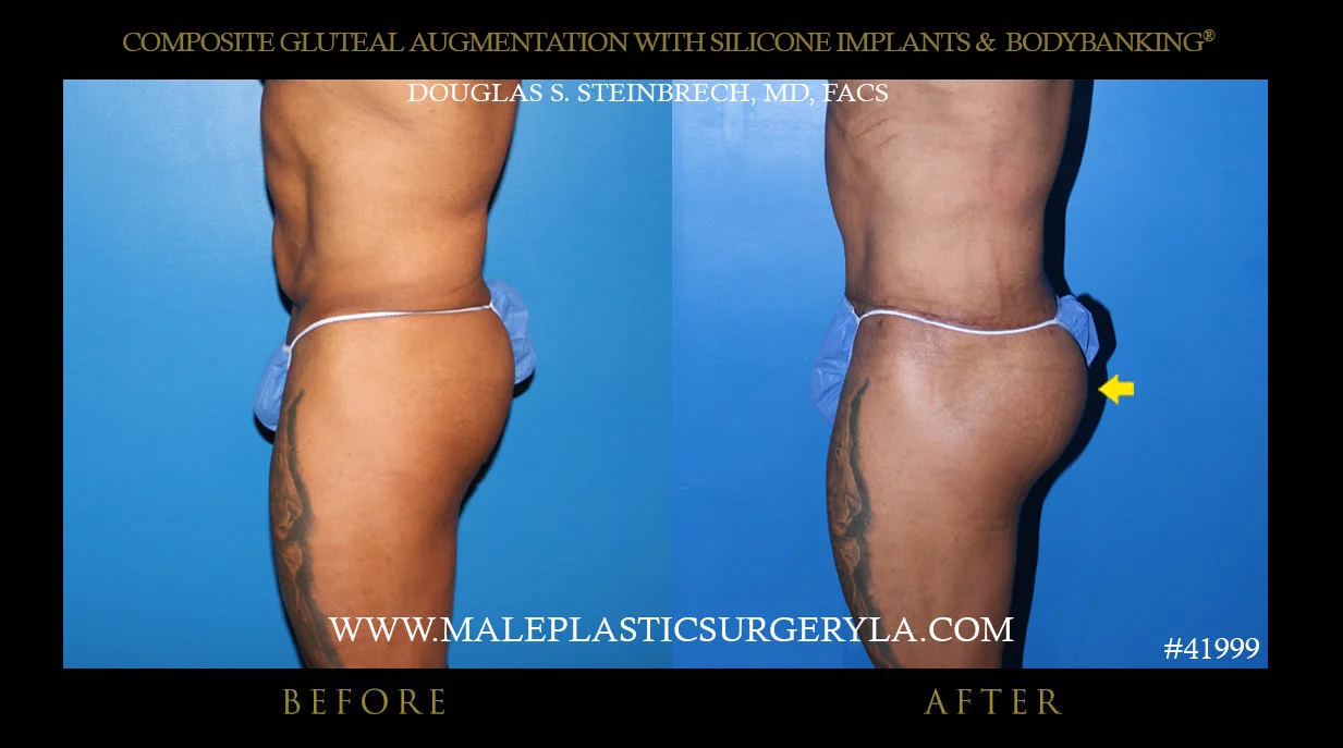 Gluteal Buttock Implants - Before & After Photos