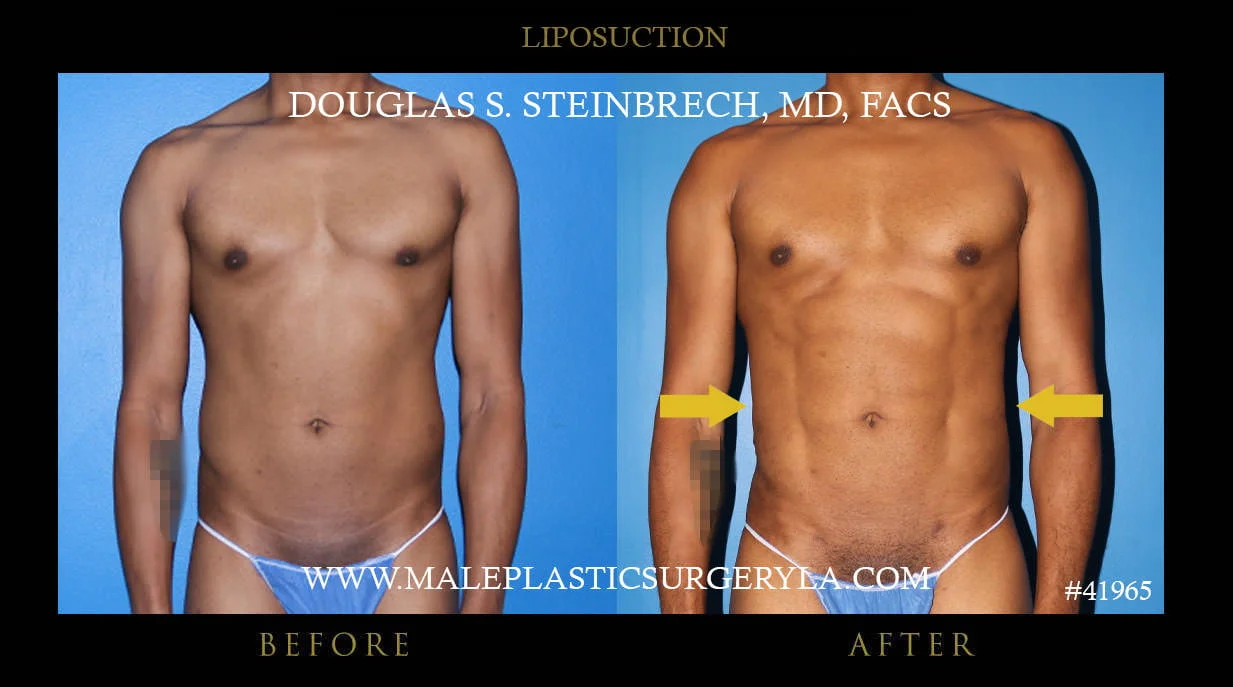 Liposuction - Before & After Photos