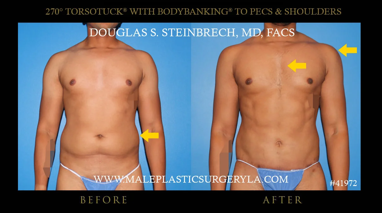 Torsotuck - Before & After Photos