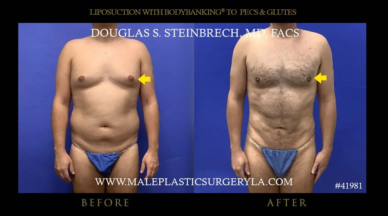 Liposuction - Before & After Photos