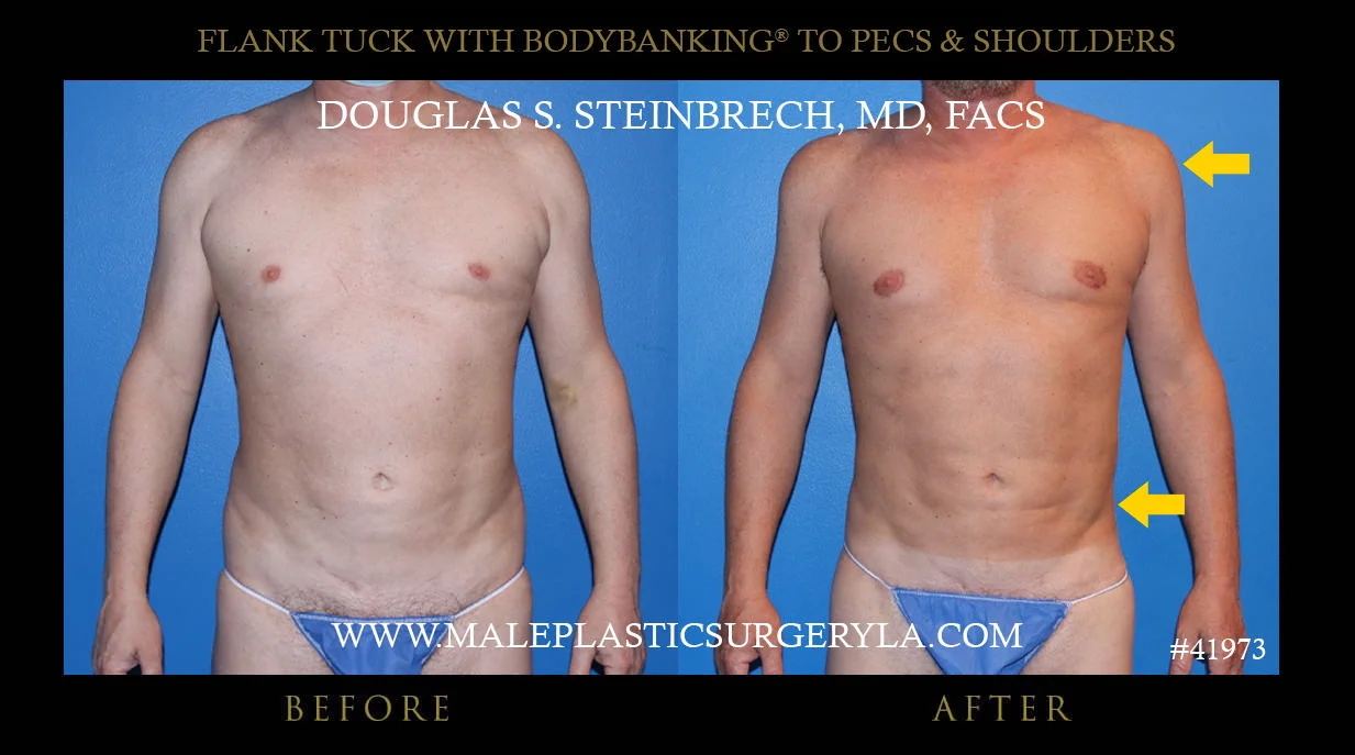 Torsotuck - Before & After Photos