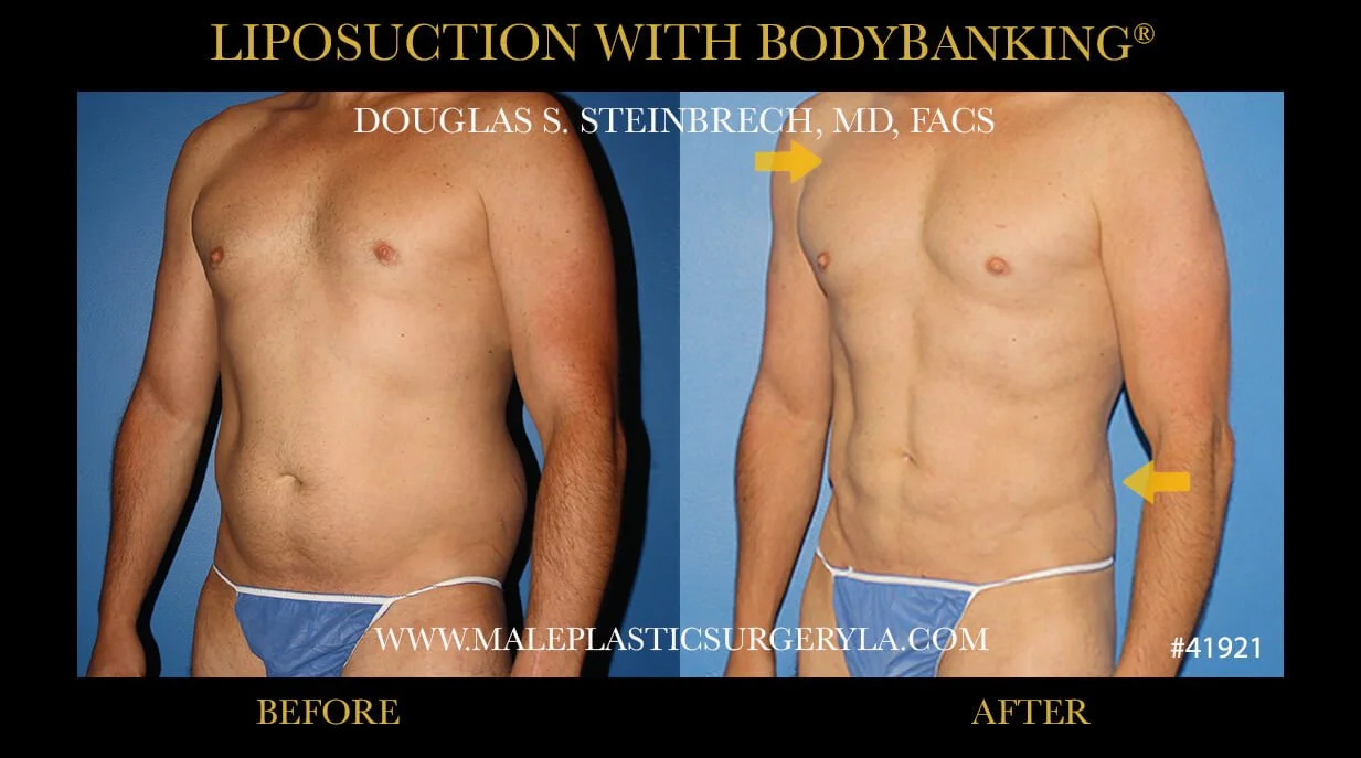 Liposuction - Before & After Photos